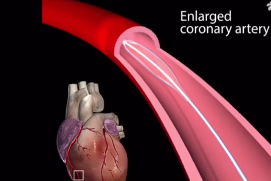 بالون آنژیو پلاستی SC balloon angioplasty